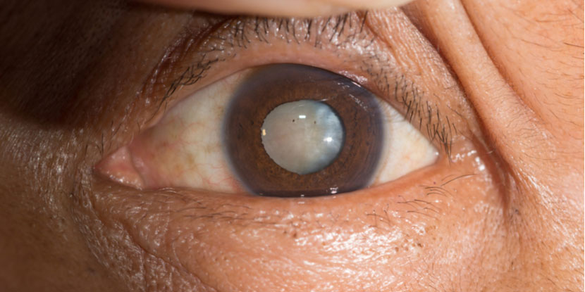 Ojo con catarata